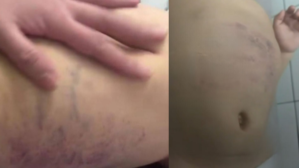 «Өз әкесі аяусыз сабаған»: Зардап шеккен 3 жасар бүлдіршіннің жағдайы белгілі болды (ФОТО)