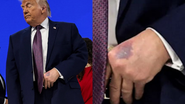 «Жиі қол алысудан болған физикалық жүктеме»: Ақ үй Трамптың денсаулығына қатысты мәлімдеме жасады