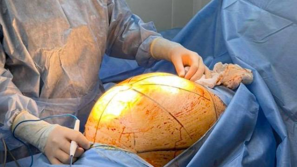  "Қымбат қоспаларды ішкен. Көлемі 55×35 сантиметр болатын ірі ісікке айналған".  Алматы тұрғыны ауруын жасырамын деп ажал тырнағына іліне жаздады